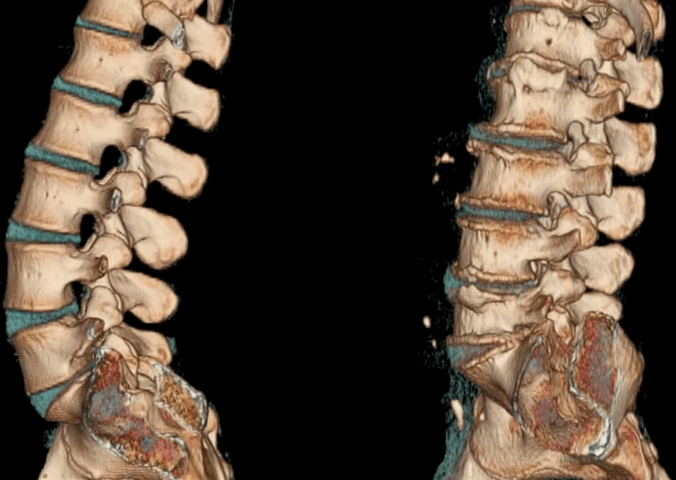 osteocondrosis