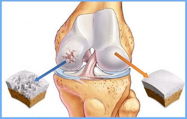 Articulación de rodilla normal y afectada por osteoartritis