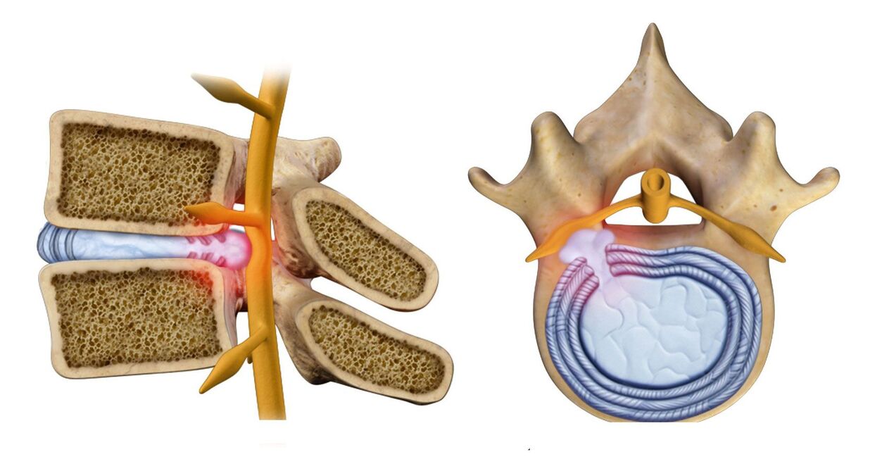 Hernia espinal en osteocondrosis torácica