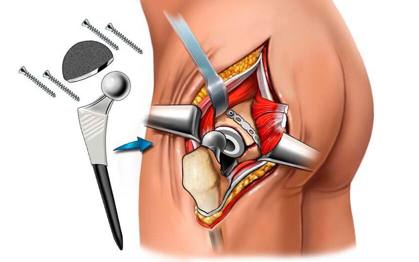 Instalación de una endoprótesis una solución quirúrgica al problema de la coxartrosis