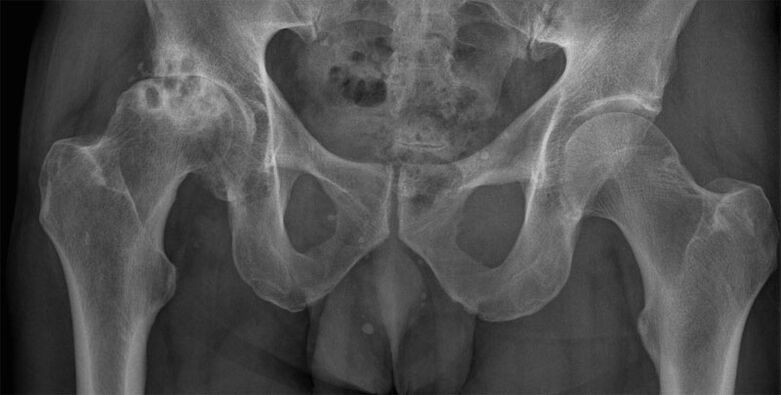 Osteoartritis deformante de la articulación de la cadera en las radiografías