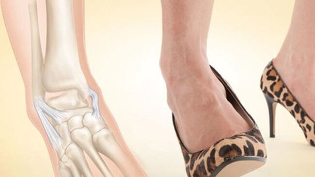 usar zapatos con tacones como causa de la osteoartritis del tobillo