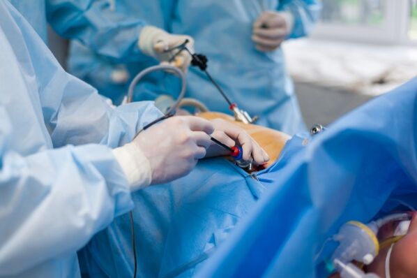 En una etapa avanzada de osteocondrosis de la columna lumbar, se requiere cirugía. 