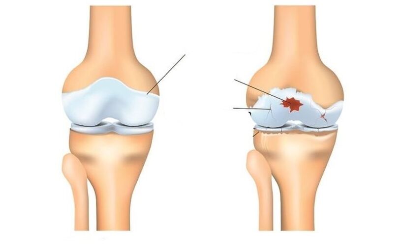 Sano y paciente con artrosis articulaciones